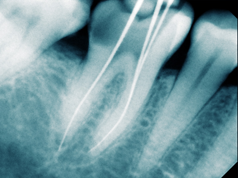 endodonzia